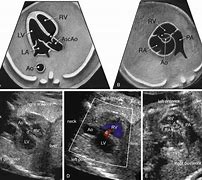 Image result for Rvot and LVOT Fetal Ultrasound Images Colour