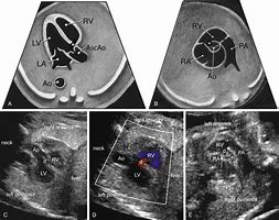 Image result for LVOT Rvot Ultrasound