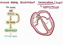 Image result for Atrioventricular Reciprocating Tachycardia