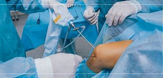 Image result for Arthroscopic Surgery Meniscus