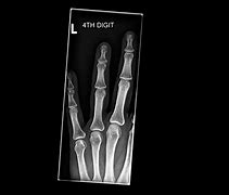 Image result for PA Finger X-ray