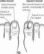 Image result for Pedicure for Ingrown Toenail