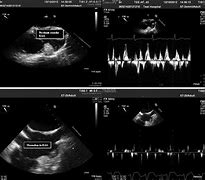 Image result for Right Atrial Appendage Thrombus