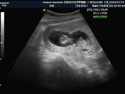 Image result for 3 Month Pregnancy Ultrasound