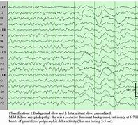 Image result for Toxic Encephalopathy