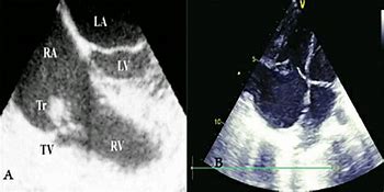 Image result for Sessile Thrombus