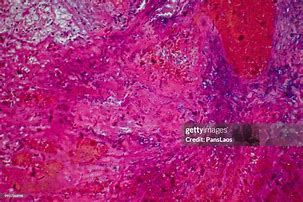 Image result for Hemangioma Tumor