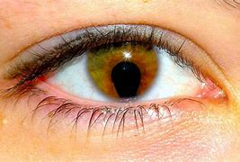 Image result for Cat Eye Syndrome