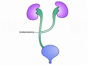 Image result for Long Tunnel Ureter