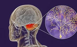 Image result for Cerebral Ataxia