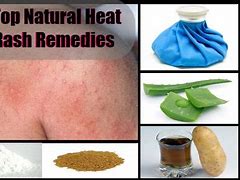 Image result for Soap for Heat Rash