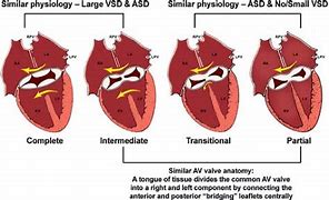 Image result for Complete Atrioventricular Canal Defect