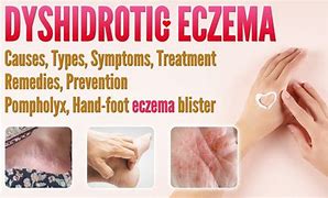 Image result for Best Treatment for Dyshidrotic Eczema