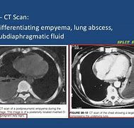 Image result for Thoracic Empyema On Percussion