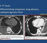 Image result for Empyema Thoracis X-ray