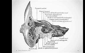 Image result for Mastoiditis