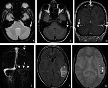 Image result for Thrombose Veineuse Musculaire IRM