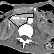 Image result for Pheochromocytoma CT Abdomen