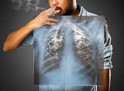 Image result for Chronic Emphysema