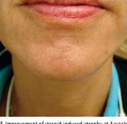 Image result for Skin Atrophy Diagram