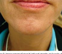 Image result for Sclerotic Atrophy of Skin