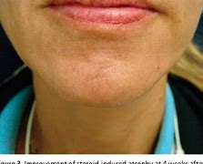 Image result for De Qinjection Atrophy Skin