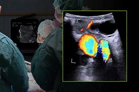 Image result for Cholecystectomy Ultrasound