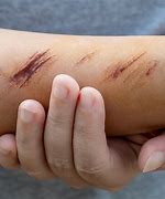 Image result for Skin Laceration Down to the Dermis