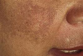 Image result for Pimple Black Spot