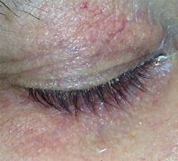 Image result for Demodex On Face