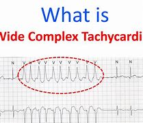 Image result for Polymorphic Wide Complex Tachycardia