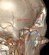 Image result for Zygomatico Orbital Artery