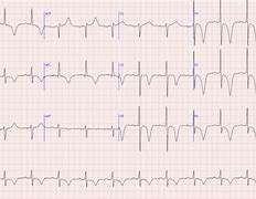 Image result for Acral Ischemia