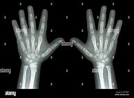 Image result for Child's Hand X-ray