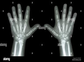 Image result for Thumb X-ray Child