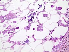 Image result for Necrosis Histology