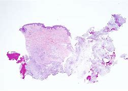 Image result for Actinomycetoma