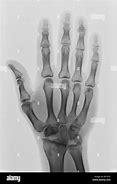 Image result for Normal Hand Radiograph