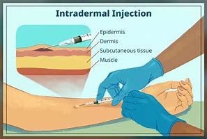 Image result for Subcutaneous Injection