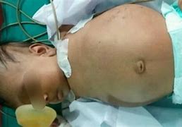 Image result for Parasitic Twin