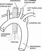 Image result for Retrocaval Artery