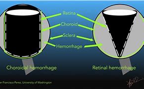 Image result for Orbital Hemorrhage CT