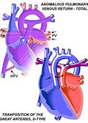 Image result for Cyanotic Heart Defect