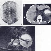 Image result for MIBG Pheochromocytoma