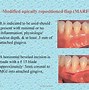 Image result for Attached Gingiva