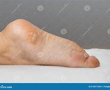 Image result for HPV Plantar Warts