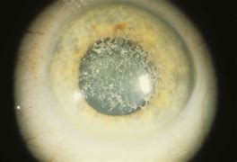 Image result for Corneal Defect