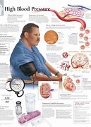 Image result for High Blood Pressure Treatment