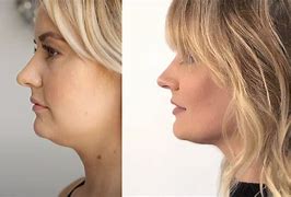 Image result for CoolSculpting Chin Before and After