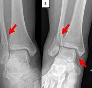 Image result for Lateral Malleolus Fracture Splint